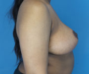 after breast reduction right side view case 2715