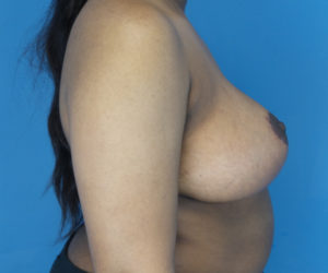 after breast reduction right side view case 2715
