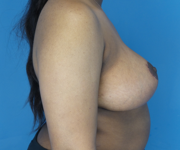 after breast reduction right side view case 2715