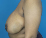 before breast reduction left side view case 2715