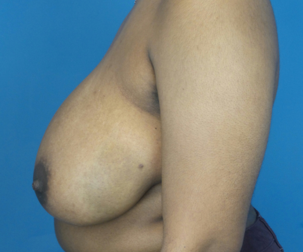before breast reduction left side view case 2715