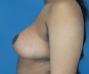 after breast reduction left side view case 2715