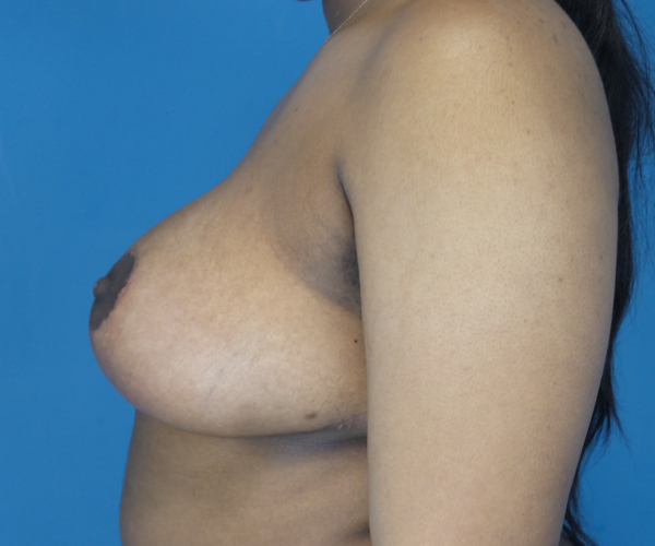 after breast reduction left side view case 2715
