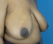 before breast reduction right angle view case 2715