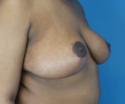 after breast reduction right angle view case 2715