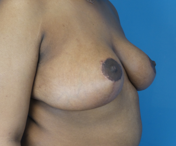 after breast reduction right angle view case 2715