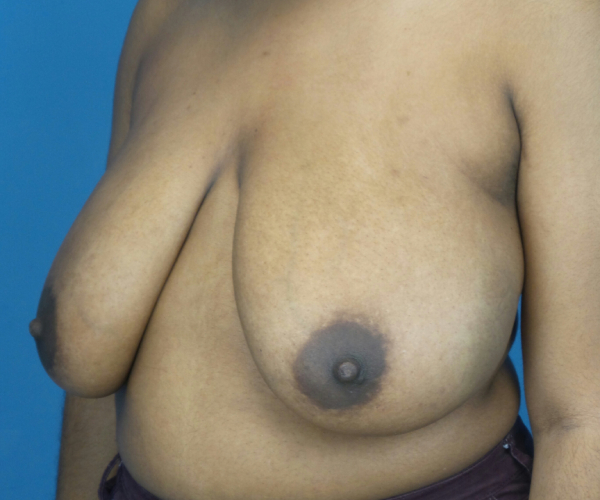 before breast reduction left angle view case 2715