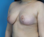 after breast reduction left angle view case 2724