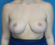after breast reduction front view case 2731