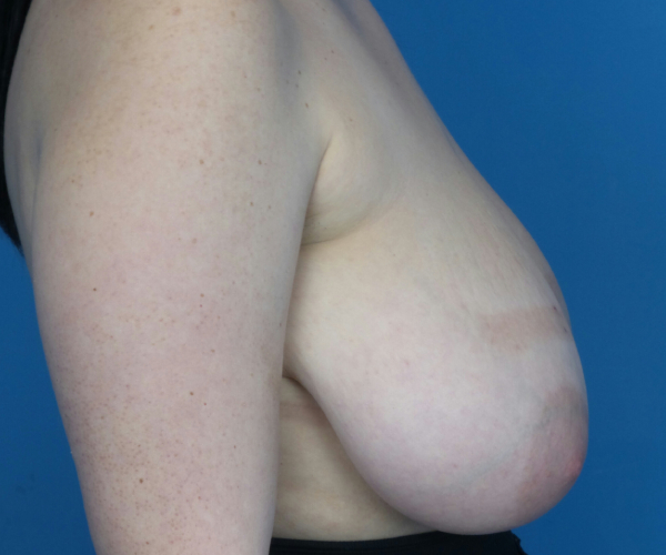 before breast reduction right side view case 2731