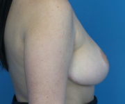 after breast reduction right side view case 2731