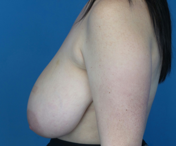 before breast reduction left side view case 2731