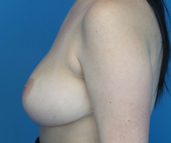 after breast reduction left side view case 2731
