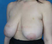 before breast reduction left angle view case 2731