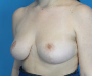 after breast reduction left angled view case 2731