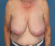 before breast reduction front view case 2742