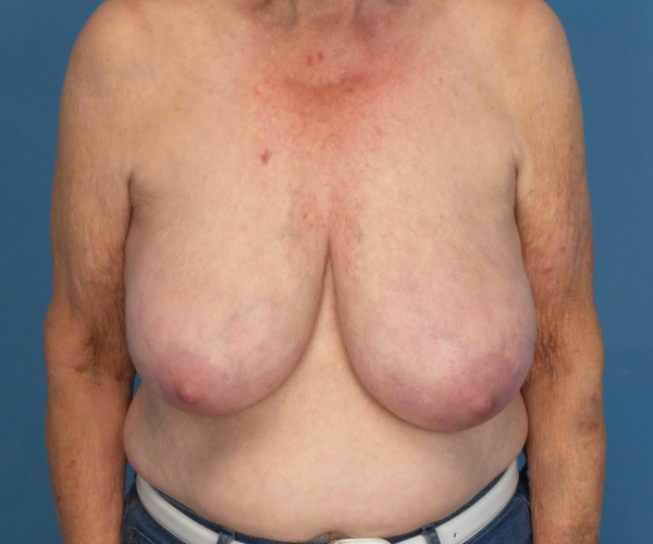 before breast reduction front view case 2742