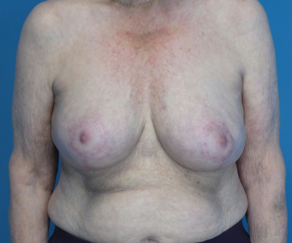 after breast reduction front view case 2742