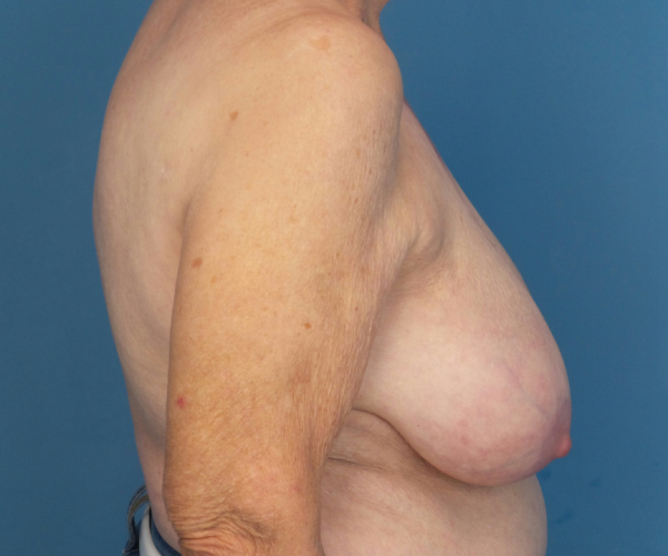 before breast reduction right side view case 2742