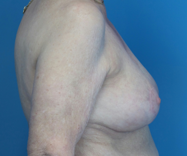 after breast reduction right side view case 2742