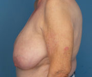 before breast reduction left side view case 2742