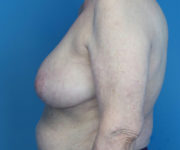 after breast reduction left side view case 2742