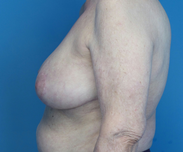 after breast reduction left side view case 2742