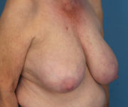 before breast reduction right angle view case 2742