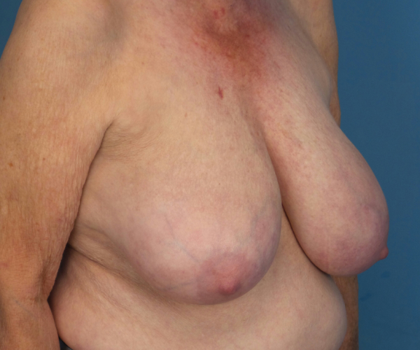 before breast reduction right angle view case 2742