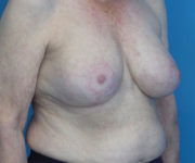 after breast reduction right angle view case 2742