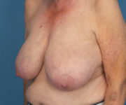 before breast reduction left angle view case 2742