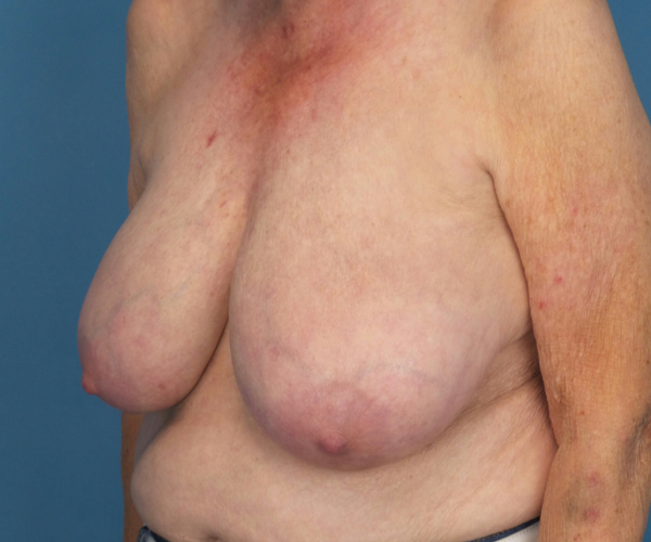 before breast reduction left angle view case 2742