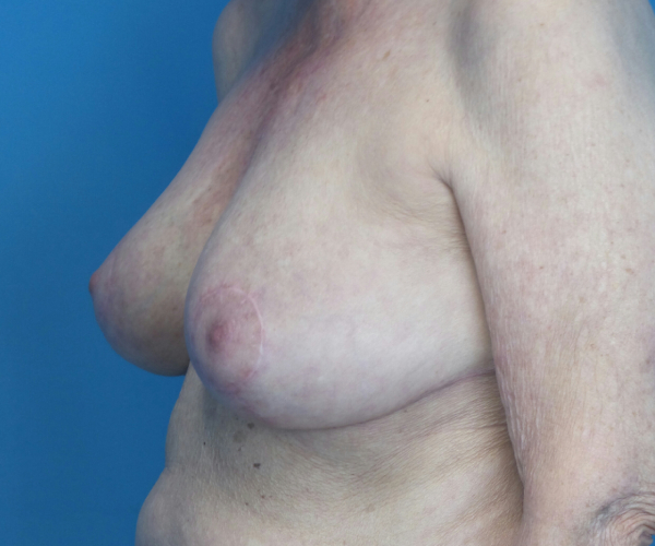 after breast reduction left angle view case 2742