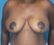 after breast reduction front view case 2753