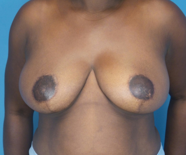after breast reduction front view case 2753