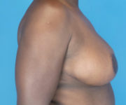 after breast reduction right side view case 2753