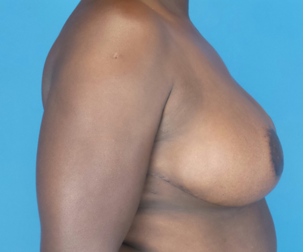 after breast reduction right side view case 2753