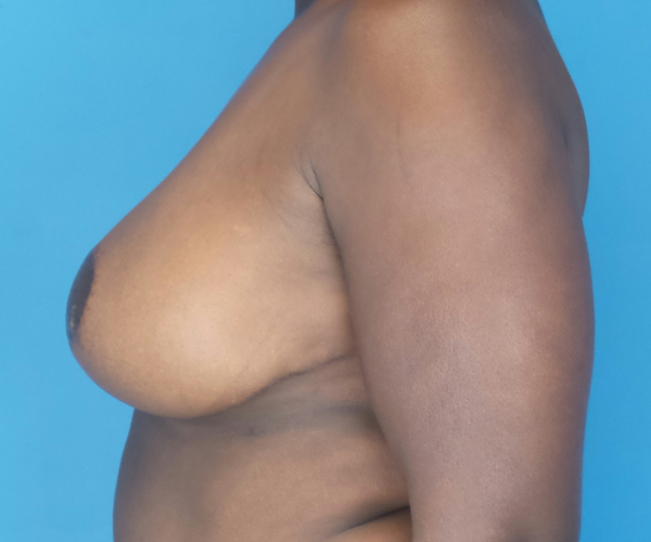 after breast reduction left side view case 2753