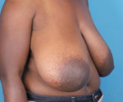 before breast reduction right angled view case 2753