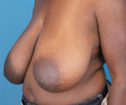 before breast reduction left angled view case 2753