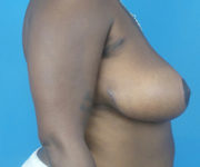 after breast reduction right side view case 2911