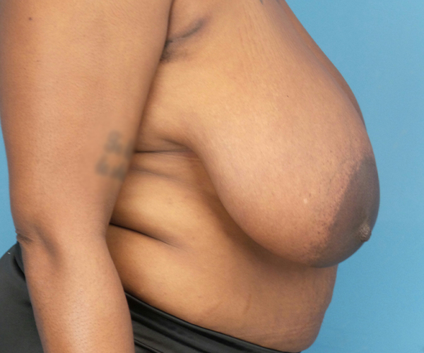 before breast reduction right side view case 2911
