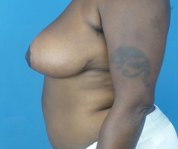 after breast reduction left side view case 2911