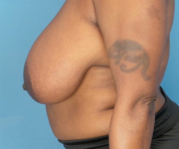 before breast reduction left side view case 2911