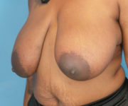 before breast reduction left angled view case 2911