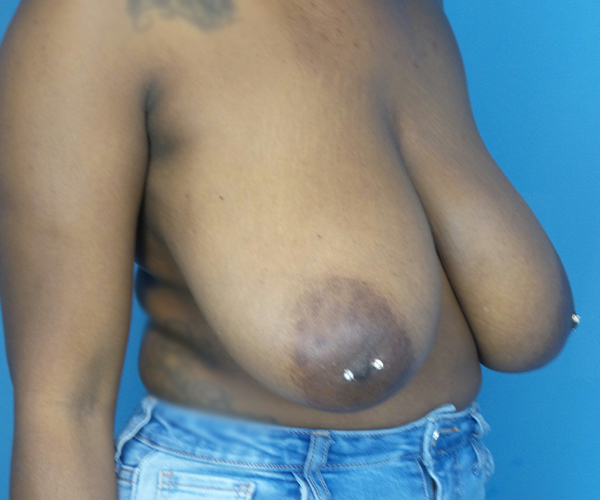 before breast reduction right angled view case 2920