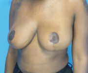 after breast reduction left angled view case 2920