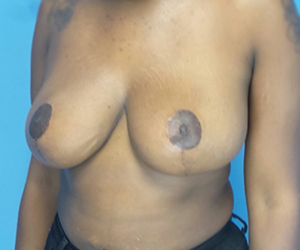 after breast reduction left angled view case 2920