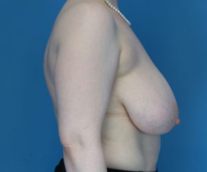 before breast reduction right side view case 3867