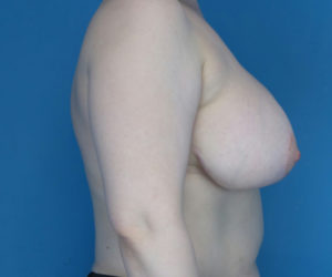 after breast reduction right side view case 3867